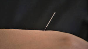 Expert Acupuncturist Performing Skin Treatment Wallpaper